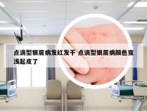 点滴型银屑病发红发干 点滴型银屑病颜色变浅起皮了