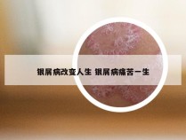 银屑病改变人生 银屑病痛苦一生