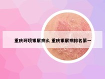 重庆环境银屑病么 重庆银屑病排名第一