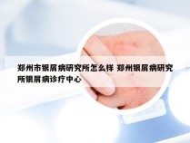 郑州市银屑病研究所怎么样 郑州银屑病研究所银屑病诊疗中心