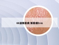 66温银屑病 银屑病trm