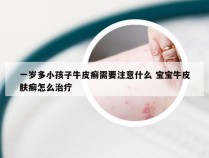 一岁多小孩子牛皮癣需要注意什么 宝宝牛皮肤癣怎么治疗