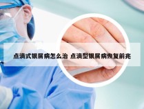 点滴式银屑病怎么治 点滴型银屑病恢复前兆