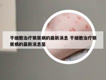 干细胞治疗银屑病的最新消息 干细胞治疗银屑病的最新消息是