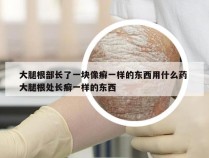 大腿根部长了一块像癣一样的东西用什么药 大腿根处长癣一样的东西