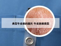 典型牛皮癣的图片 牛皮肤癣类型