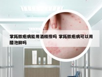 掌跖脓疱病能用酒精擦吗 掌跖脓疱病可以用醋泡脚吗