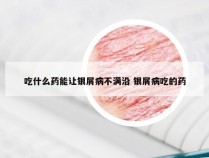 吃什么药能让银屑病不满沿 银屑病吃的药