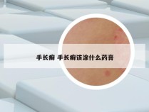 手长癣 手长癣该涂什么药膏