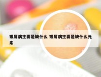 银屑病主要是缺什么 银屑病主要是缺什么元素