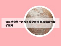 银屑病会从一两片扩散全身吗 银屑病会慢慢扩展吗