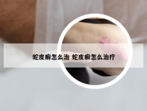 蛇皮癣怎么治 蛇皮癣怎么治疗