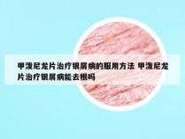 甲泼尼龙片治疗银屑病的服用方法 甲泼尼龙片治疗银屑病能去根吗