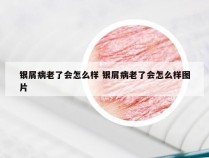 银屑病老了会怎么样 银屑病老了会怎么样图片