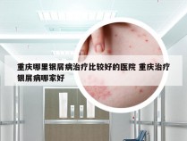 重庆哪里银屑病治疗比较好的医院 重庆治疗银屑病哪家好