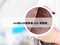 uva和uvb银屑病 uvb 银屑病