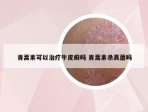 青蒿素可以治疗牛皮癣吗 青蒿素杀真菌吗