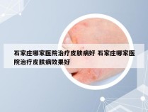 石家庄哪家医院治疗皮肤病好 石家庄哪家医院治疗皮肤病效果好