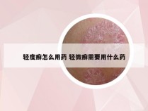 轻度癣怎么用药 轻微癣需要用什么药