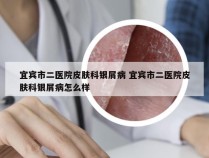 宜宾市二医院皮肤科银屑病 宜宾市二医院皮肤科银屑病怎么样