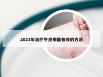 2023年治疗牛皮癣最有效的方法