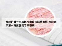 开封的第一附属医院治疗皮肤病怎样 开封大学第一附属医院专家咨询