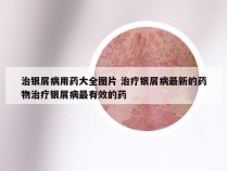 治银屑病用药大全图片 治疗银屑病最新的药物治疗银屑病最有效的药