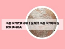 乌鲁木齐皮肤科哪个医院好 乌鲁木齐哪家医院皮肤科最好