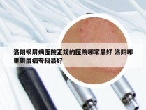 洛阳银屑病医院正规的医院哪家最好 洛阳哪里银屑病专科最好