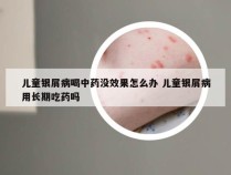 儿童银屑病喝中药没效果怎么办 儿童银屑病用长期吃药吗