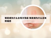 银屑病为什么会发冷发麻 银屑病为什么会有刺痛感