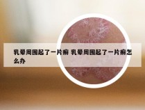 乳晕周围起了一片癣 乳晕周围起了一片癣怎么办