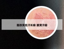 胳肢窝出汗长癣 腋窝汗藓