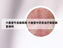 六善堂牛皮癣真假 六善堂中药膏治疗银屑病管用吗