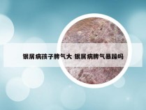 银屑病孩子脾气大 银屑病脾气暴躁吗