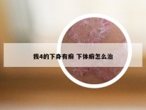 我4的下身有癣 下体癣怎么治