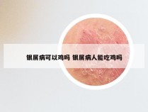 银屑病可以鸡吗 银屑病人能吃鸡吗