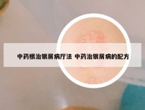 中药根治银屑病厅法 中药治银屑病的配方