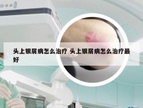 头上银屑病怎么治疗 头上银屑病怎么治疗最好