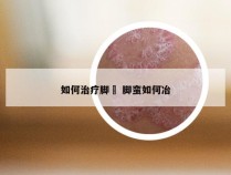 如何治疗脚廯 脚蛮如何冶