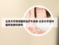 北京大学深圳医院治疗牛皮癣 北京大学深圳医院皮肤科贵吗