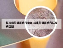 红皮病型银屑病传染么 红皮型银屑病和红皮病区别