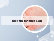 癣图片图库 癣的图片怎么治疗