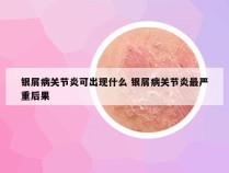 银屑病关节炎可出现什么 银屑病关节炎最严重后果