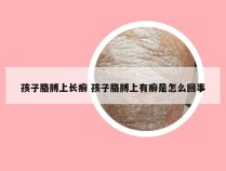 孩子胳膊上长癣 孩子胳膊上有癣是怎么回事