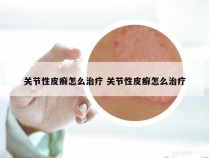 关节性皮癣怎么治疗 关节性皮癣怎么治疗