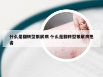 什么是翻转型银屑病 什么是翻转型银屑病患者