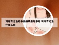 司库奇尤治疗牛皮癣效果好不好 司库奇尤治疗什么病