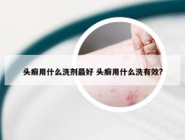 头癣用什么洗剂最好 头癣用什么洗有效?