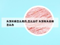 头顶长癣怎么用药,怎么冶疗 头顶有头皮癣怎么办